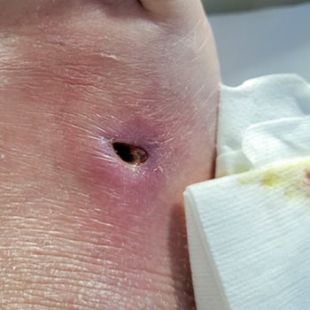 Necrotic tissue on foot